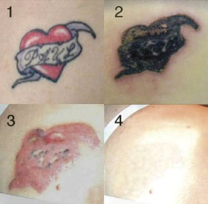 Get Rid Tattoo Review