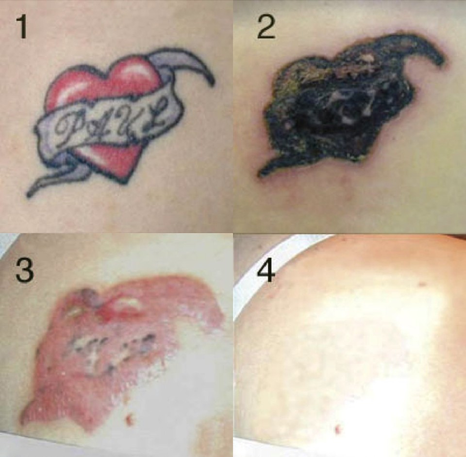 Get Rid Tattoo Review - Is Get Rid Tattoo a Scam or Not